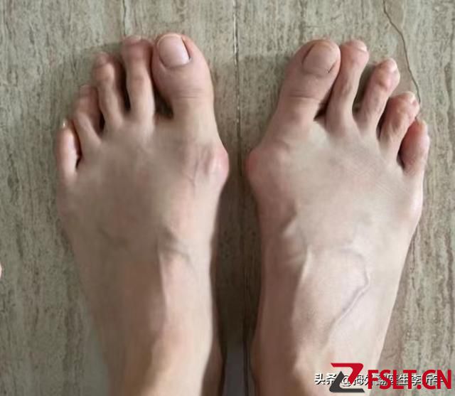 广东宝妈生孩子后拇外翻加重来做手术，一起看看恢复情况吧！